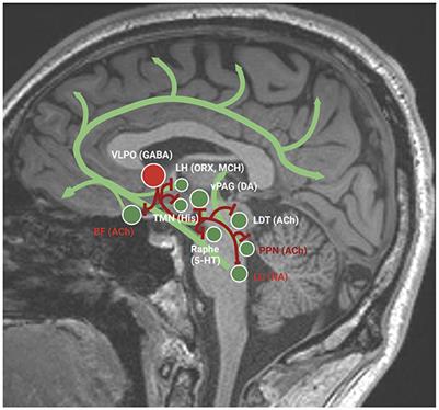 Daytime sleepiness in Parkinson's disease: a multifaceted symptom